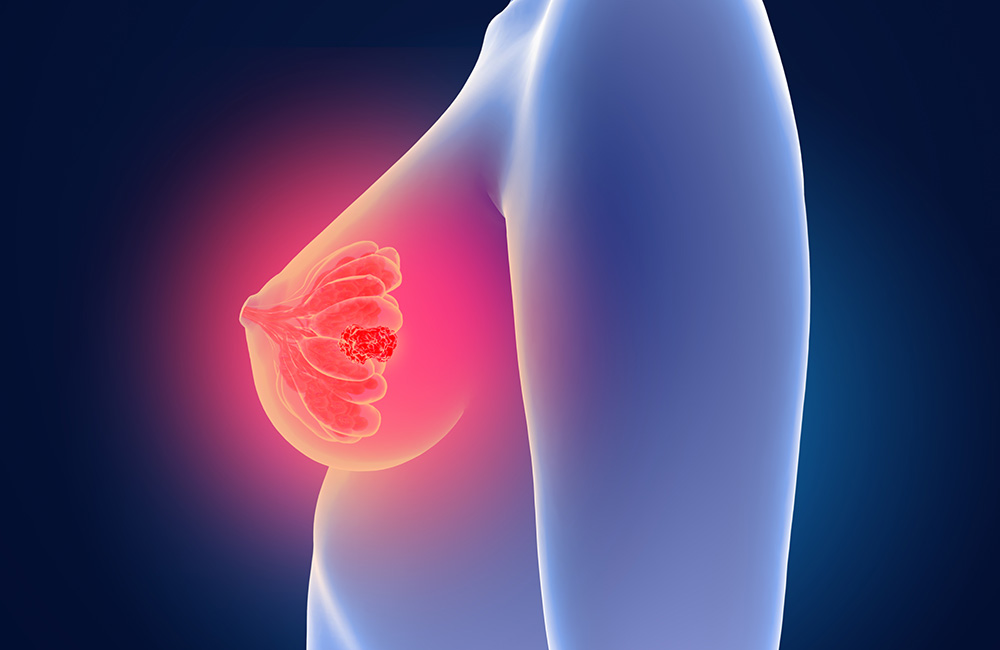 Mammakarzinom - (c) Lars Neumann - stock.adobe.com